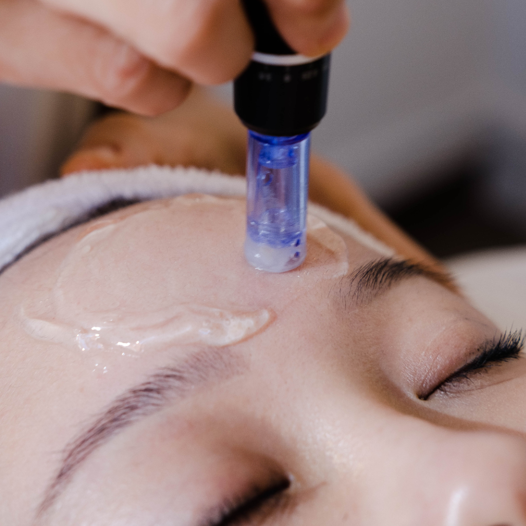 Collagen Induction Therapy (CIT) or Micro Needling